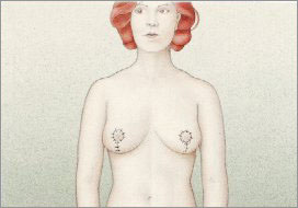 breast bursa, meme estetiği bursa, göğüs estetiği bursa